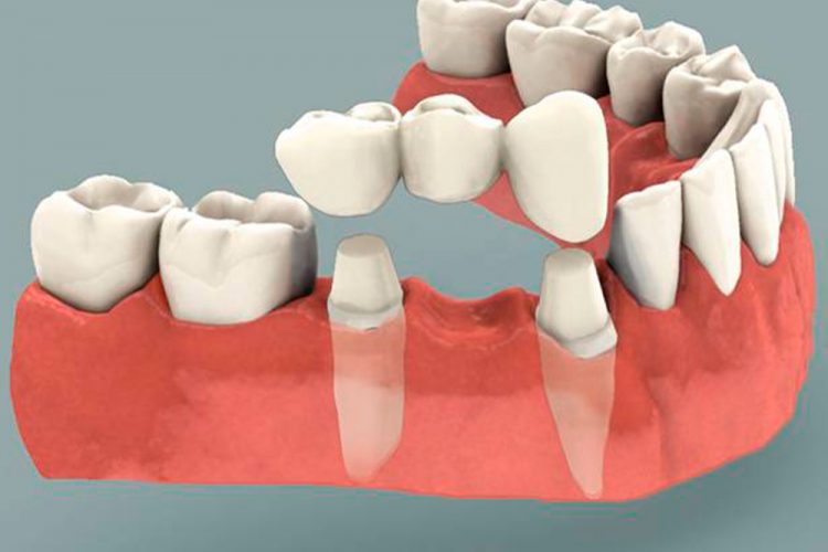 Serv-Dental-Crowns-and-Bridges
