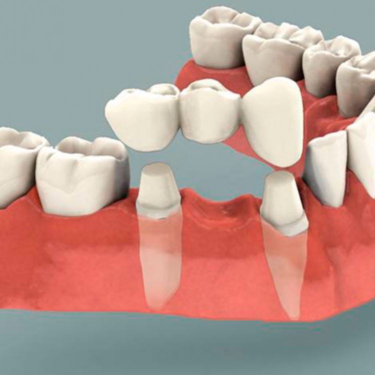 Serv-Dental-Crowns-and-Bridges