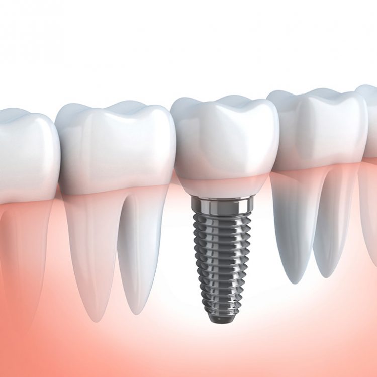 Serv-Dental-Implants